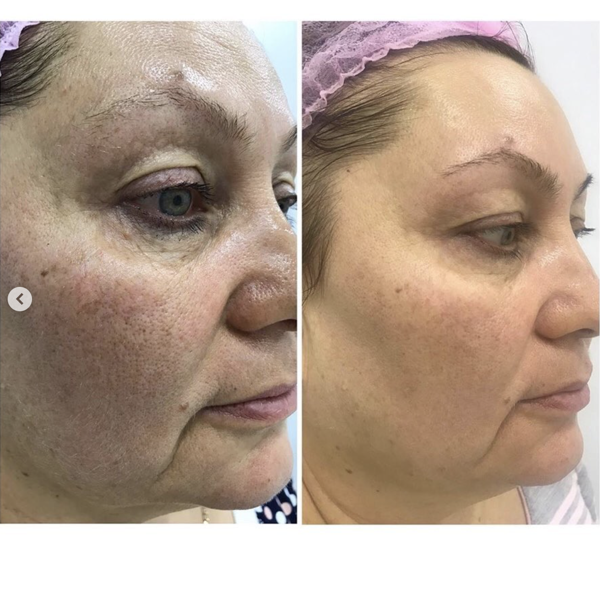 Капилляротерапия лица отзывы фото до и после Фотодинамическая терапия