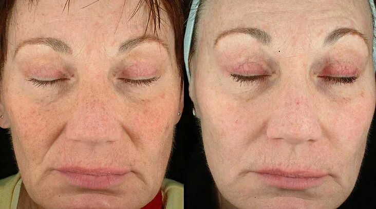 Капилляротерапия лица отзывы фото до и после Фотоденамическое моложение (фотоомоложение) в Москве - суть метода, цена и отзыв