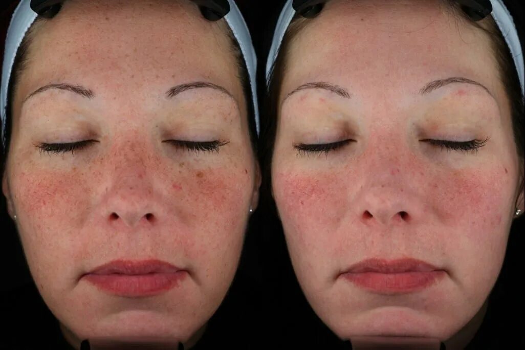 Капилляротерапия лица отзывы фото до и после dark spot treatment minneapolis - Zel Skin & Laser Specialists