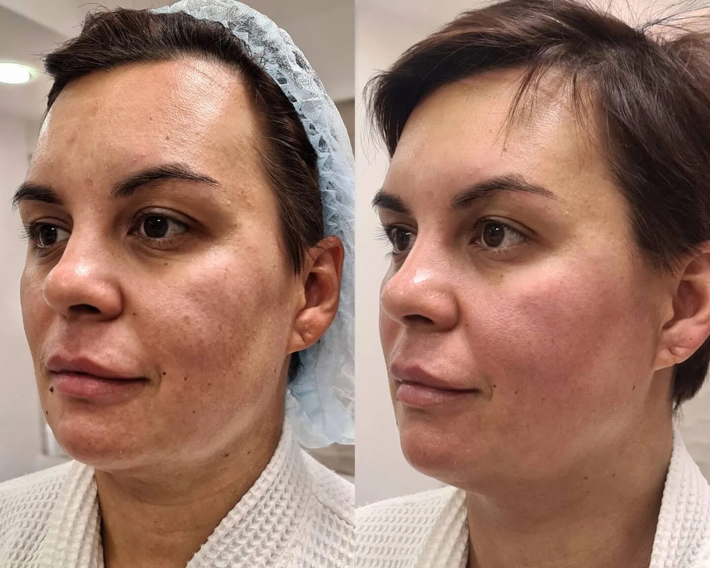 Капилляротерапия лица отзывы фото до и после Фотодинамическое омоложение кожи HELEO4 Ярославль