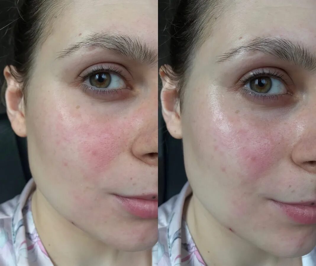 Капилляротерапия лица отзывы фото до и после В поисках эффективного ночного ухода - Kiehl's Cannabis Sativa Seed Oil Herbal C