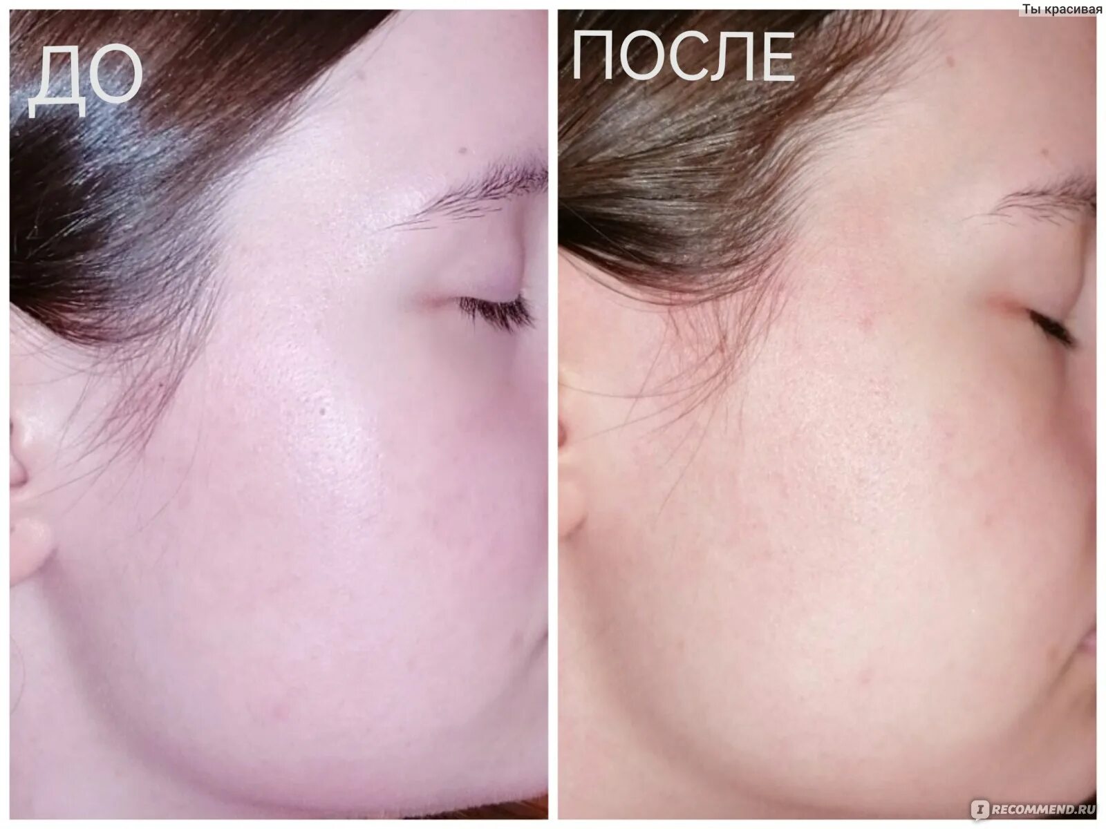 Капилляротерапия лица отзывы фото до и после Лосьон для лица Holy land cosmetics Azulene Lotion - "Оживил мою кожу+ фото ДО и