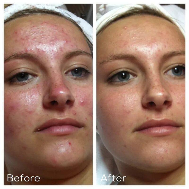 Капилляротерапия лица отзывы фото до и после hydrafacial - Cellsan Med Spa Limassol Cyprus