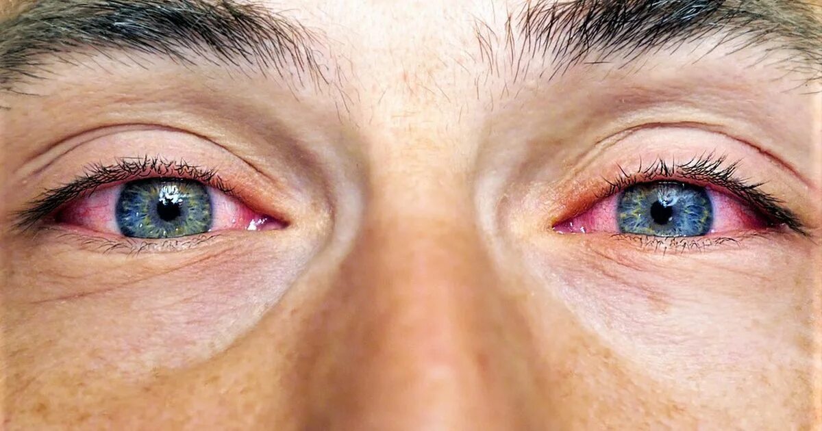 Капилляры в глазах фото Bloodshot eyes - найдено 89 картинок