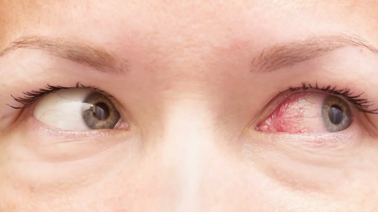 Капилляры в глазах фото The Problem With Swimming and Contact Lenses - YouTube
