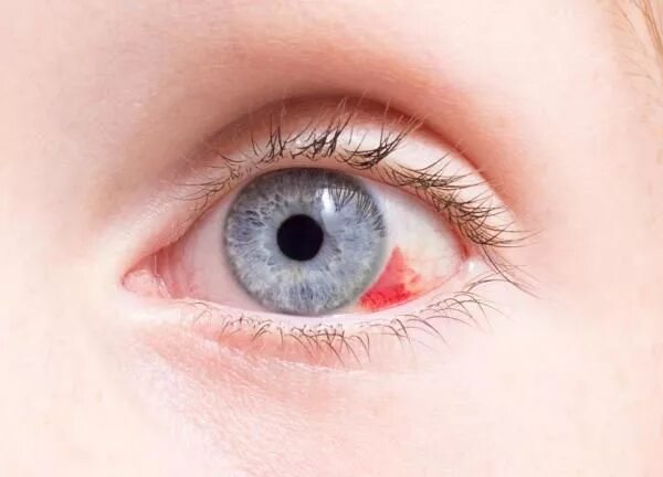 Капилляры в глазах фото Por que tenho sangue no olho - 6 passos Couleur yeux, Yeux