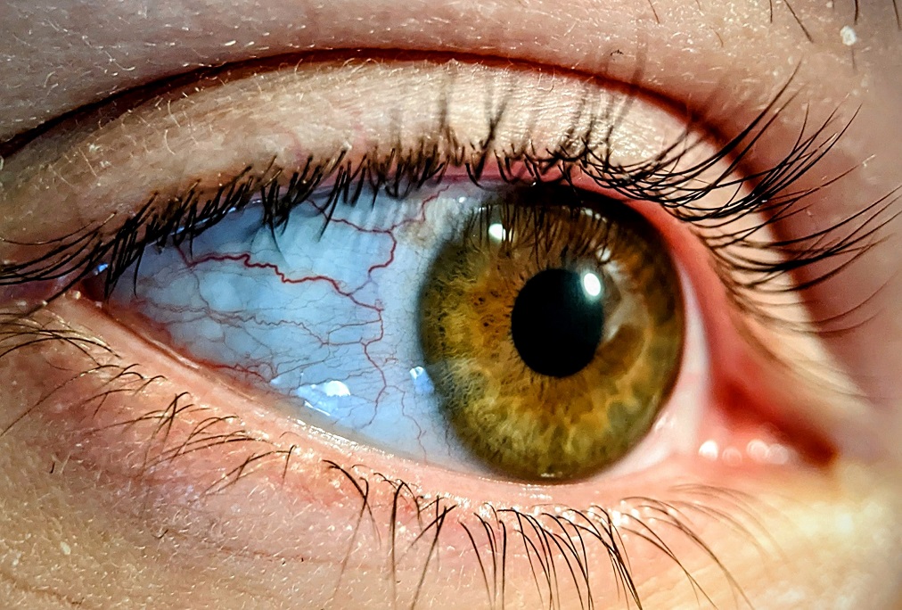 Капилляры в глазах фото Managing Dry Eye Causes & Treatment From An Optometrist