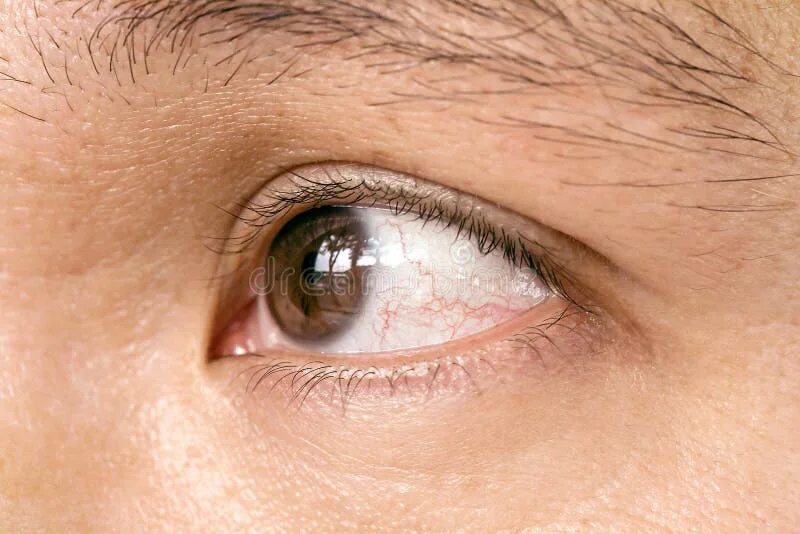Капилляры в глазах фото Conjunctivitis pupil eye stock photo. Image of close - 111405894