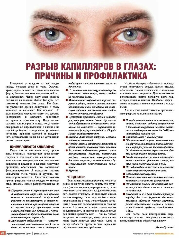 Капилляры в глазах фото Разрыв капилляров в глазах Здоровье и благополучие, Средства для восстановления 