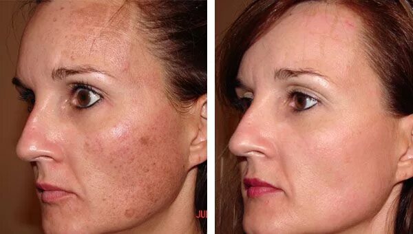 Капилярка для лица до и после фото Pin on Laser resurfacing