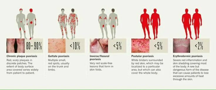 Каплевидный псориаз фото на теле симптомы Psoriasis Psoriasis guttate, Pustular psoriasis, Plaque psoriasis