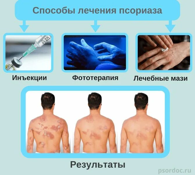 Каплевидный псориаз фото на теле симптомы Кожные заболевания поликлиника - найдено 90 картинок