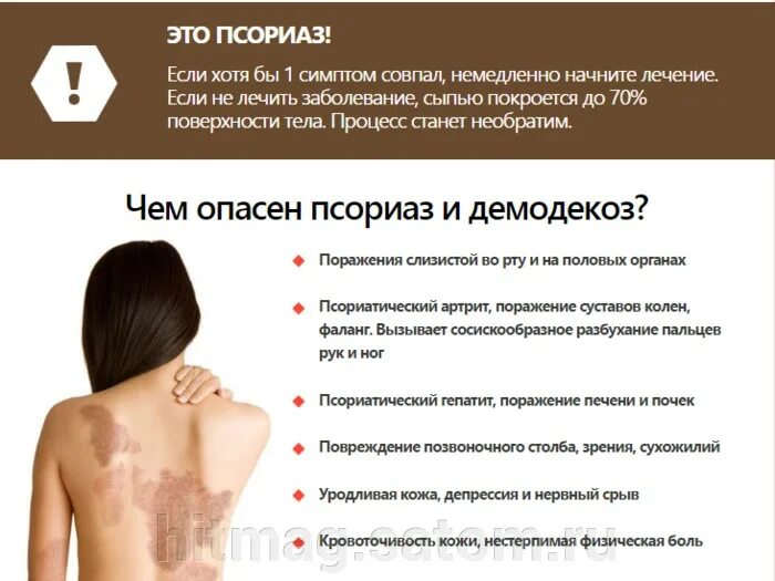 Каплевидный псориаз фото на теле симптомы Что такое псориаз - Быть здоровым - это элементарно - УЗ "16-я городская поликли