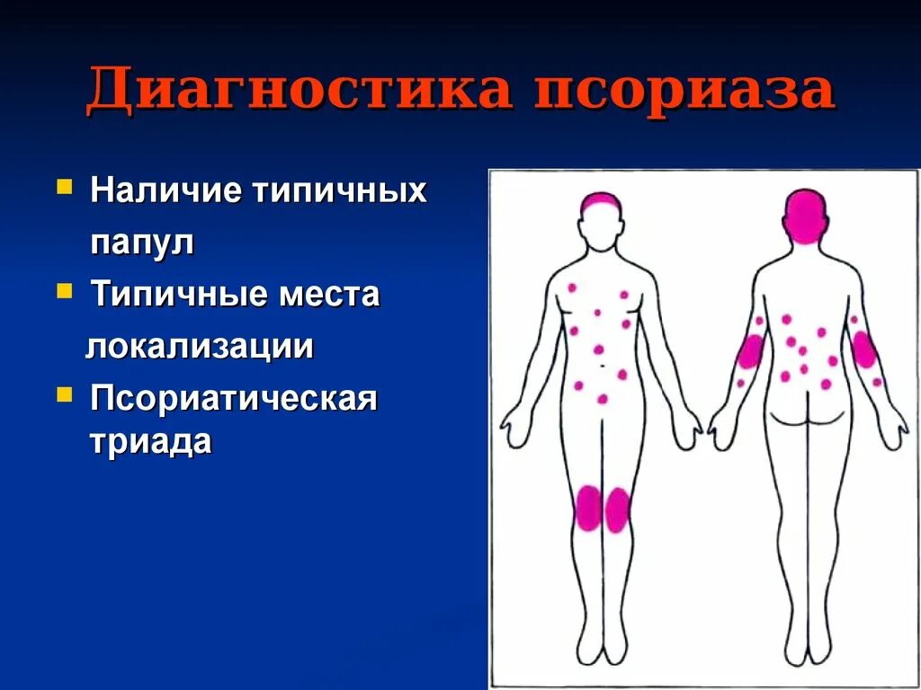 Каплевидный псориаз фото на теле симптомы Частые места локализации при чесотке: найдено 84 изображений