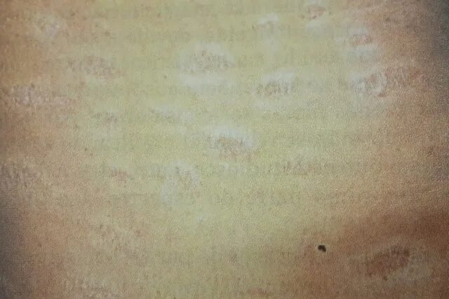 Каплевидный псориаз фото на теле симптомы How to identify and treat parapsoriasis - Bulls 2024