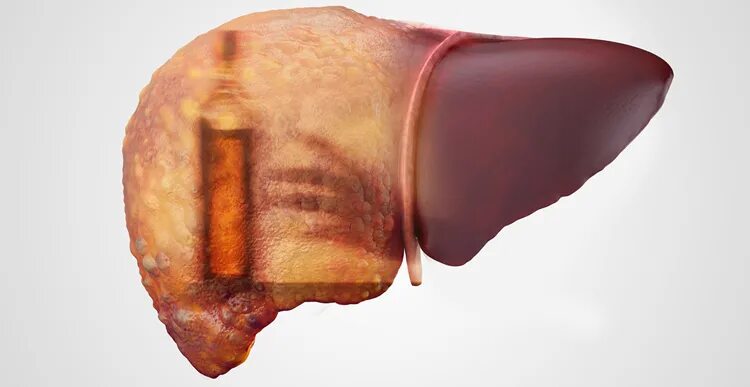 Капсула печени фото Nutrition For Fatty Liver Disease