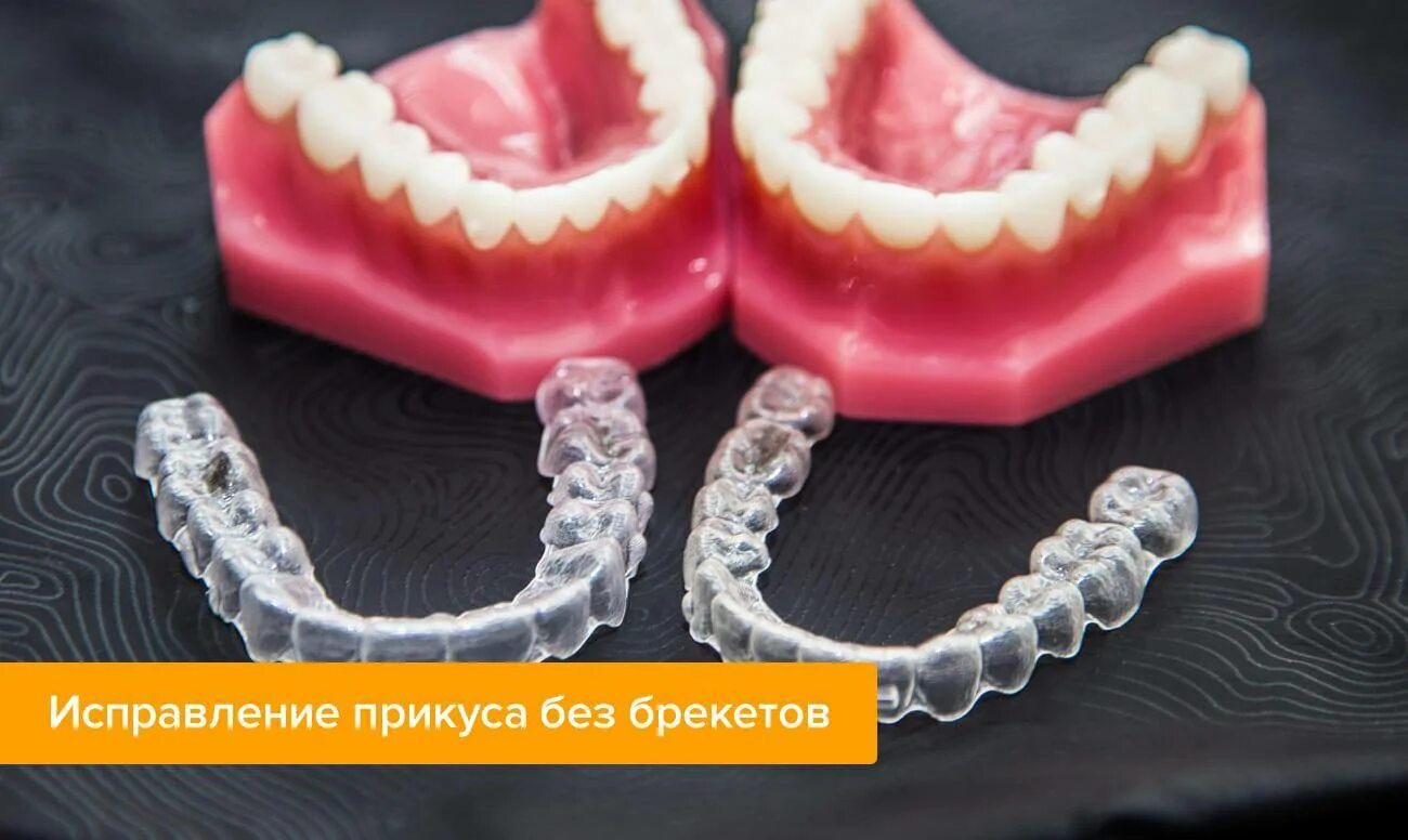 Капы для выравнивания зубов детям фото Исправление прикуса капами: особенности, виды капп, сроки лечения