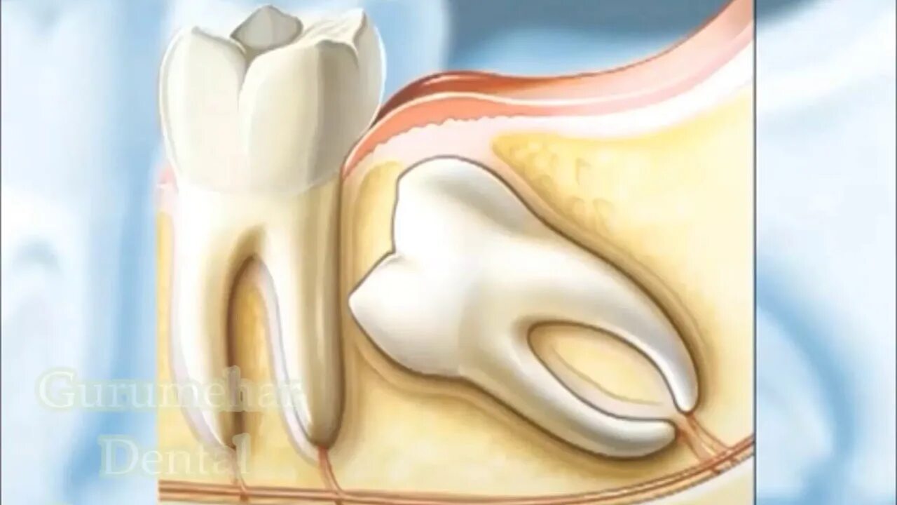 Капюшон над зубом мудрости фото 3rd molar extraction - YouTube