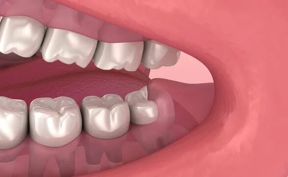 Капюшон над зубом мудрости фото Wisdom Tooth Изображения: просматривайте стоковые фотографии, векторные изображе