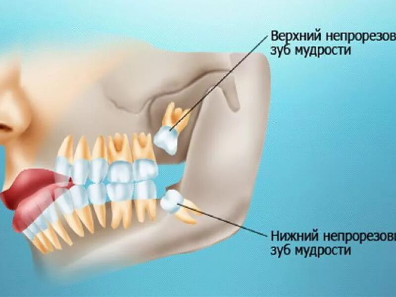 Капюшон над зубом мудрости фото Что делать после удаления зуба мудрости?
