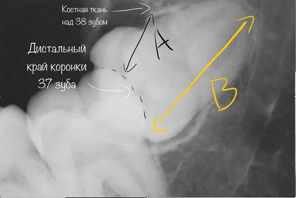 Капюшон над зубом мудрости фото Почему зуб мудрости растет криво