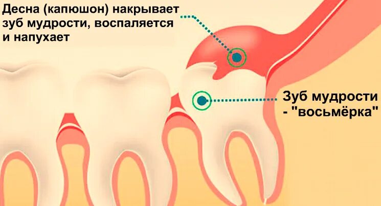 Капюшон над зубом мудрости фото Лезет зуб мудрости