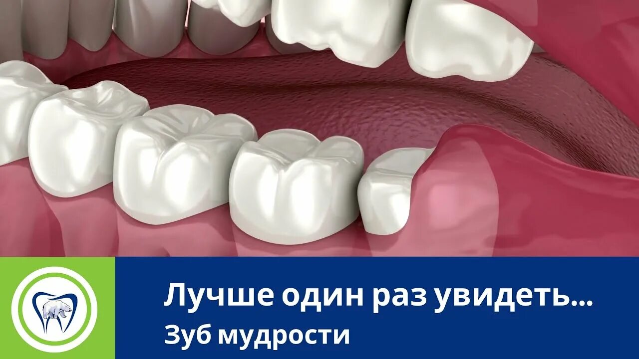 Капюшон над зубом мудрости фото Как прорезается зуб мудрости и возможные последствия. - YouTube
