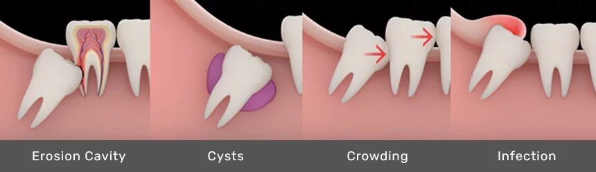 Капюшон зуба фото Wisdom Teeth Removal