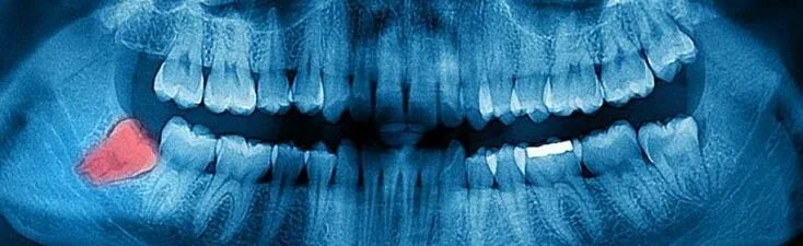 Капюшон зуба фото #dentalimplantsbeforeafter #healthy #Implant #Scattered #Teeth #Tooth #ToothImpl
