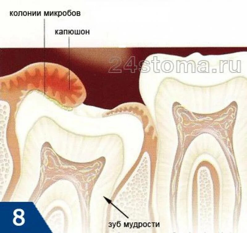 Капюшон зуба фото Зубная впадина 8 букв - найдено 83 фото