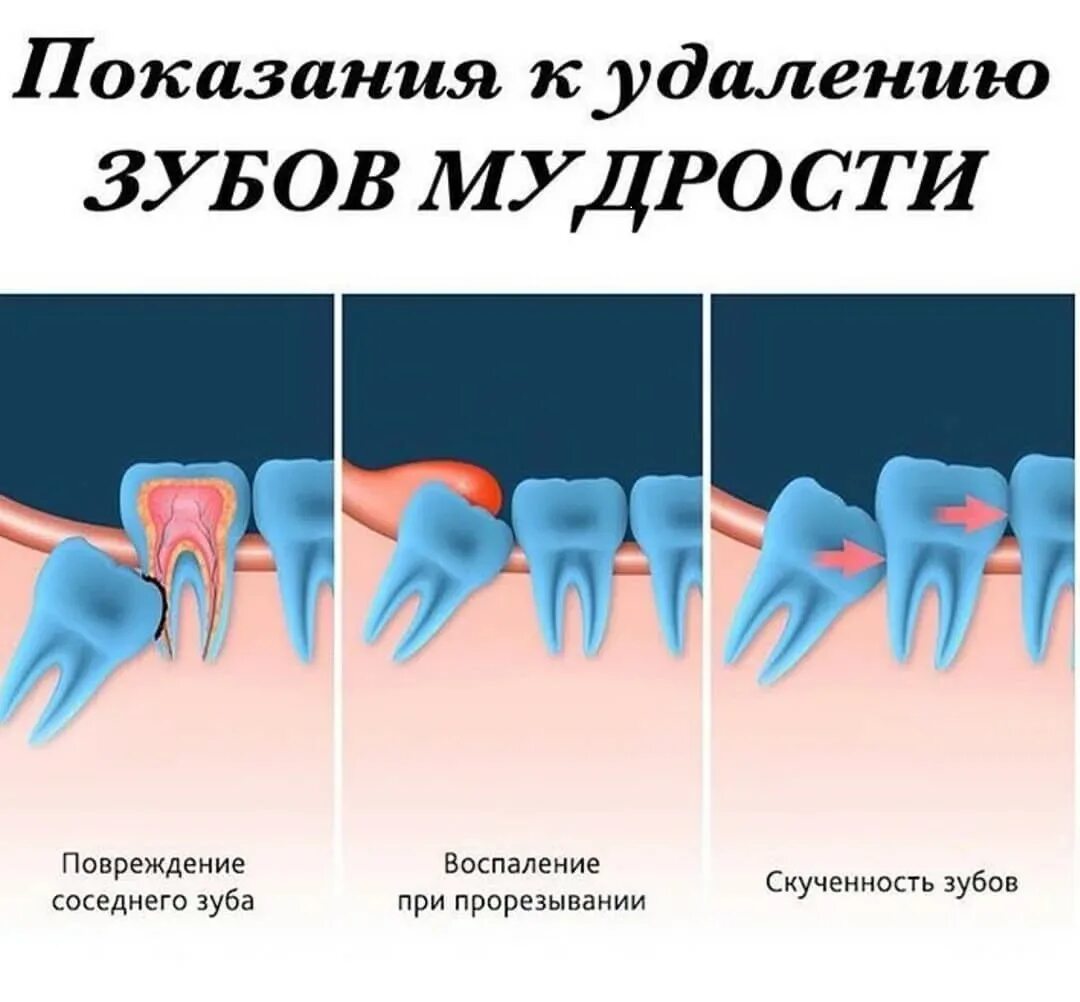 Капюшон зуба мудрости фото Боль после удаления зуба мудрости! Nika Esthetic