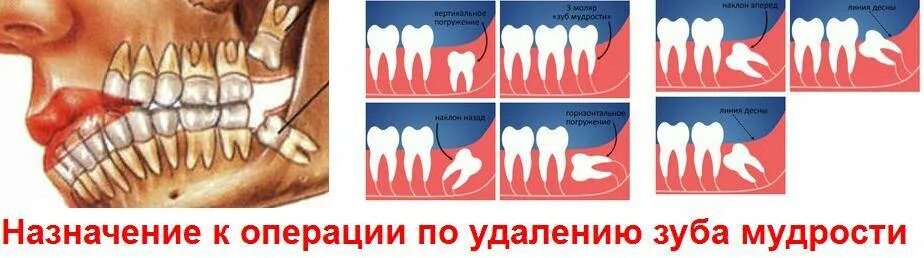 Капюшон зуба мудрости фото Удаление зуба мудрости схема
