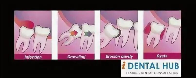 Капюшон зуба мудрости фото Pin on Dental Surgery Food Dentists