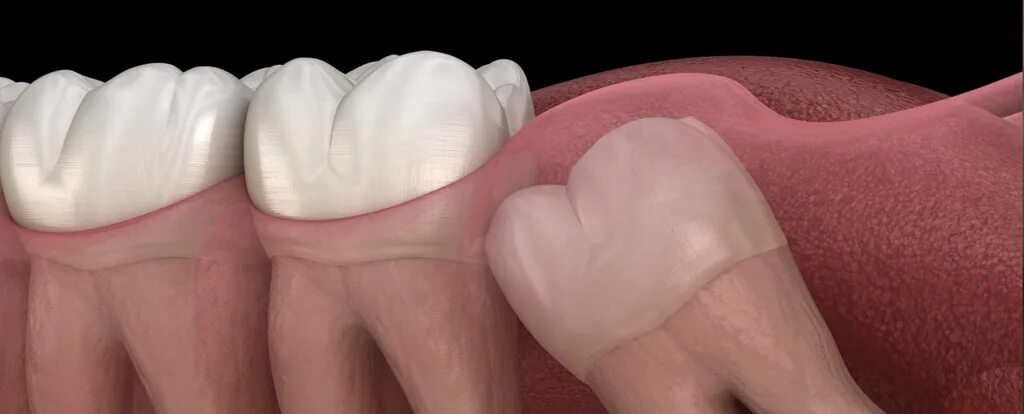 Капюшон зуба мудрости фото Блог клиники Colibri Dental