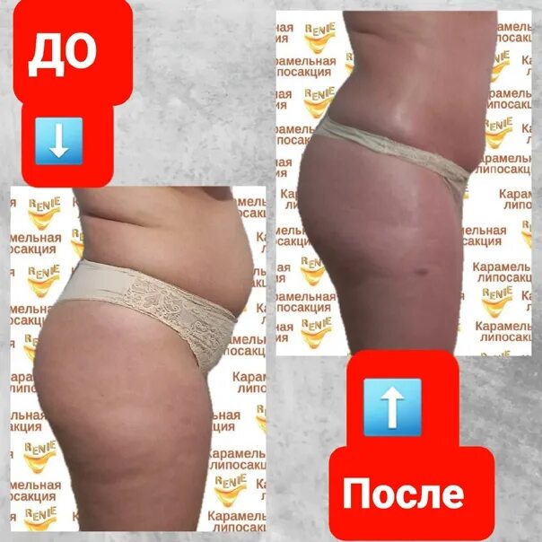 Карамельная липосакция лица до и после фото Картинки карамельная липосакция