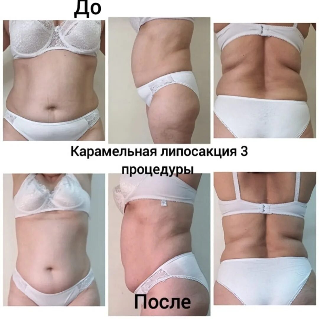 Карамельная липосакция лица до и после фото В новый год с телом мечты 2022 Массаж-Ейск Карамелька ВКонтакте