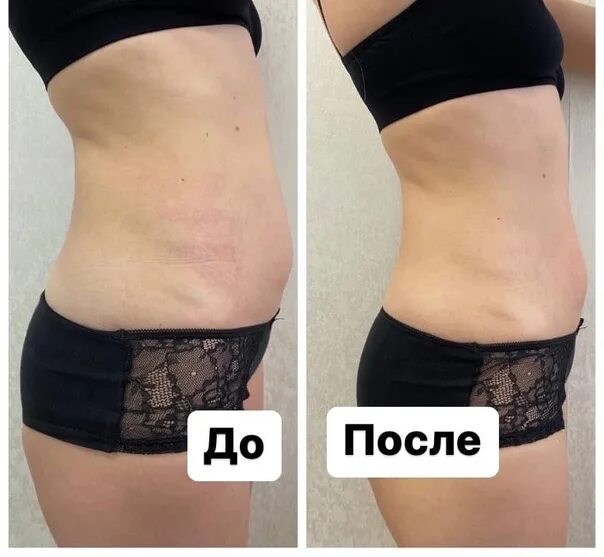 Карамельная липосакция лица до и после фото Do you want to quickly get rid of extra sm? Caramel Liposuction To You in Help !