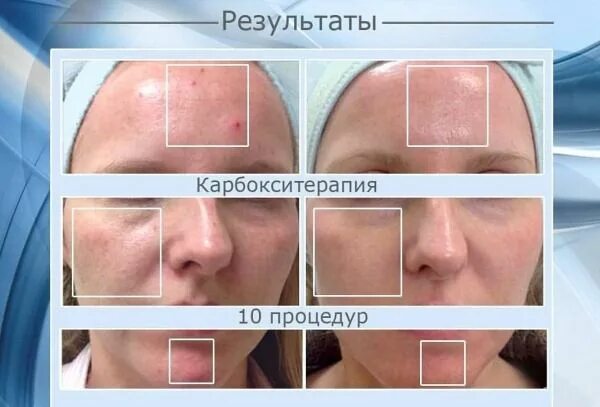 Карбокситерапия лица фото до и после Статьи - Карбокситерапия для лица. Что это такое?