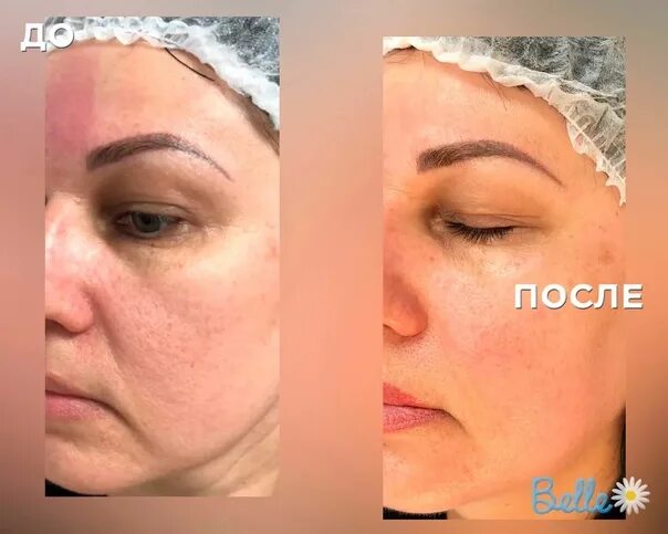 Карбокситерапия отзывы фото до и после Фотографии со страницы сообщества "Карбокситерапия Челябинск" - Фотография 1 из 