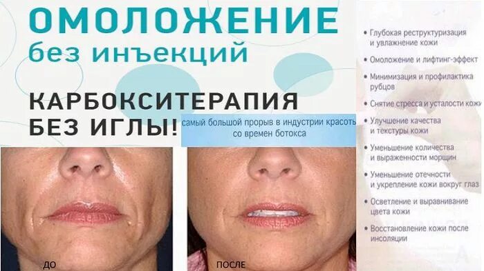 Карбокситерапия отзывы фото до и после карбокси6. RIBESKIN