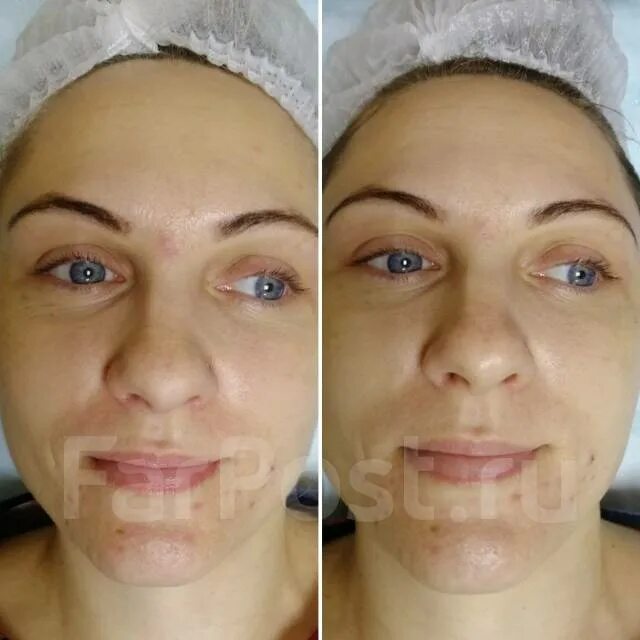 Карбокситерапия отзывы фото до и после МК Неинвазивная карбокситерапия Aravia Professional. Бесплатно 21.06.23 во Влади