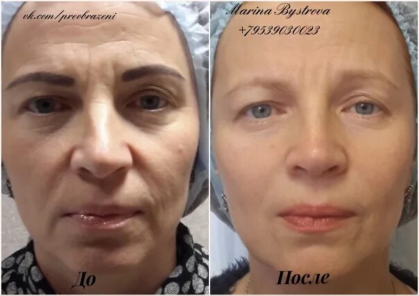 Карбокситерапия отзывы фото до и после Марина Быстрова: записи профиля ВКонтакте