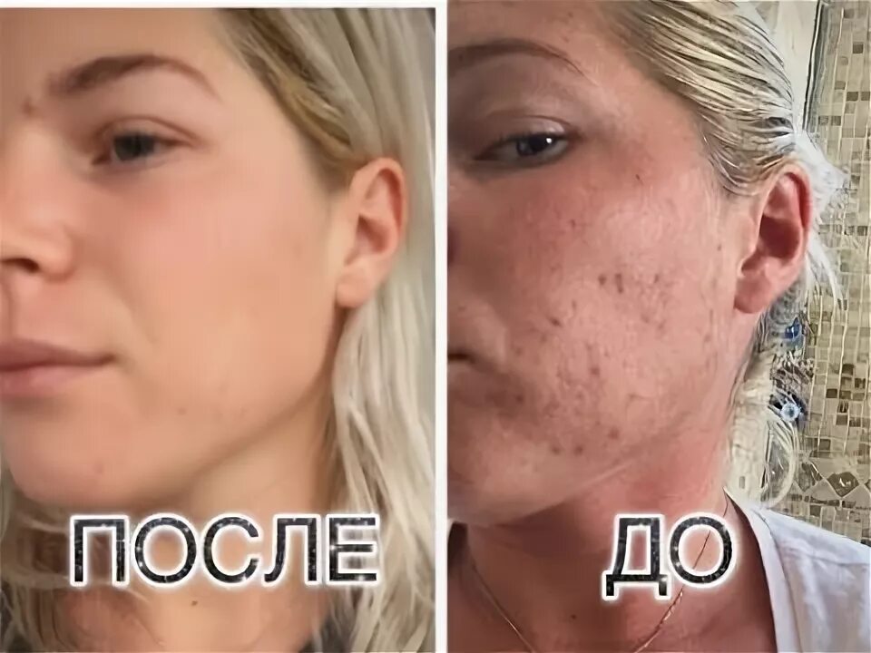 Карбокситерапия отзывы фото до и после КАРБОКСИТЕРАПИЯ: Омоложение лица углекислым газом, БЕЗИНЪЕКЦИОННАЯ - YouTube