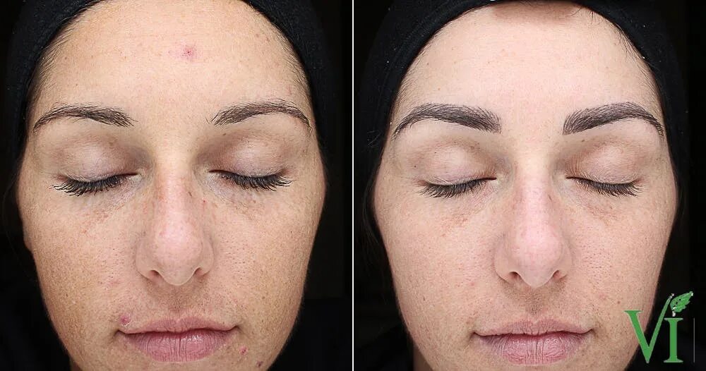Карбоновый пилинг фото до и после реальные Tone Texture Gallery Aesthera MedSpa