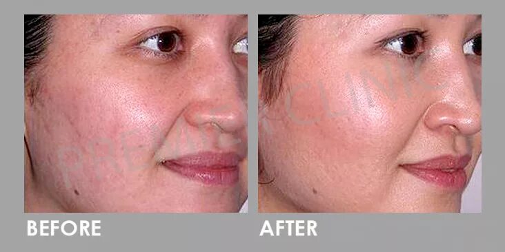Карбоновый пилинг фото до и после реальные Large Pores Tightening with Carbon Peel Laser Premier Clinic