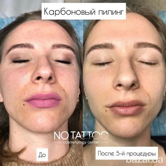 Карбоновый пилинг фото до и после реальные Карбоновый пилинг - Услуги, Красота, здоровье, Макияж, косметология, наращивание
