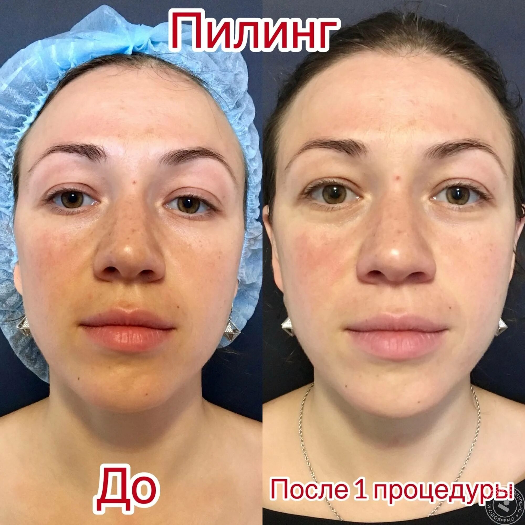 Карбоновый пилинг фото до и после реальные Миндальный пилинг в домашних условиях и салоне: фото лица до и после процедуры, 