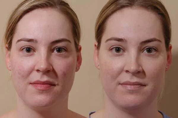 Карбоновый пилинг лица до после фото Laser Surgery Gallery - Bel-Red Plastic Surgery - Seattle, WA Skin primer, Prime
