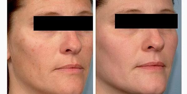 Карбоновый пилинг лица до после фото Chemický peeling