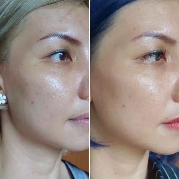 Карбоновый пилинг отзывы фото до и после We Offer Express - Recovery ! All-season carbon peeling ! - Fits all - It's pain